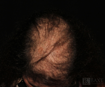 Hair Restoration Before - Paramus, NJ