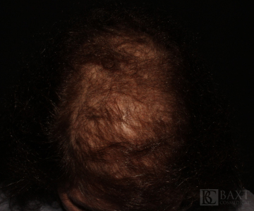 Hair Restoration After - Paramus, NJ
