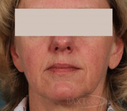 Rosacea Treatment Before - Paramus, NJ Rosacea Treatment Before - Paramus, NJ
