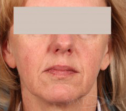 Rosacea Treatment After - Paramus, NJ Rosacea Treatment After - Paramus, NJ