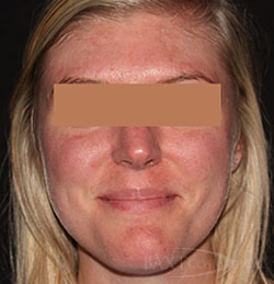 Rosacea Treatment Before - Paramus, NJ