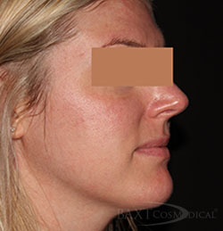 Rosacea Treatment After - Paramus, NJ