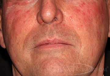 Before Rosacea Patients