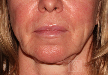 Rosacea Treatment After - Paramus, NJ Rosacea Treatment After - Paramus, NJ