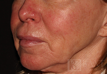 Rosacea Treatment Before - Paramus, NJ Rosacea Treatment Before - Paramus, NJ