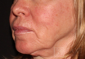 Rosacea Treatment After - Paramus, NJ Rosacea Treatment After - Paramus, NJ