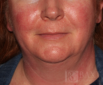 Rosacea Treatment Before - Paramus, NJ Rosacea Treatment Before - Paramus, NJ