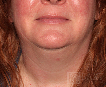 Rosacea Treatment After - Paramus, NJ Rosacea Treatment After - Paramus, NJ