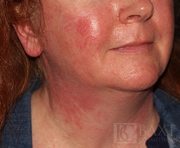 Rosacea Treatment Before - Paramus, NJ Rosacea Treatment Before - Paramus, NJ