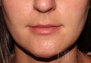 Rosacea Treatment After - Paramus, NJ Rosacea Treatment After - Paramus, NJ