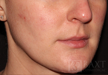 Rosacea Treatment Before - Paramus, NJ