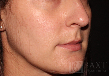 Rosacea Treatment After - Paramus, NJ Rosacea Treatment After - Paramus, NJ