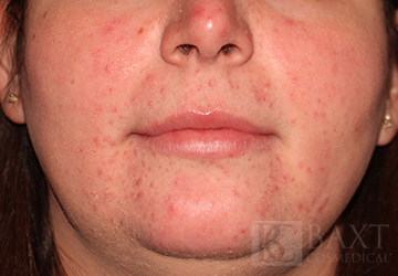 Rosacea Treatment Before - Paramus, NJ