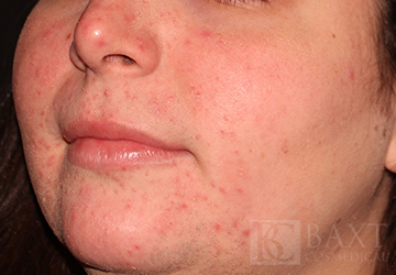 Rosacea Treatment Before - Paramus, NJ