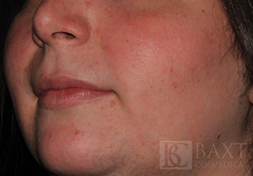 Rosacea Treatment After - Paramus, NJ Rosacea Treatment After - Paramus, NJ