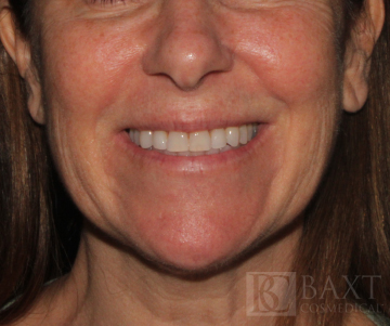 Rosacea Treatment Before - Paramus, NJ Rosacea Treatment Before - Paramus, NJ