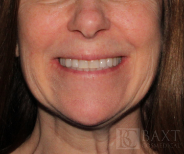 Rosacea Treatment After - Paramus, NJ Rosacea Treatment After - Paramus, NJ