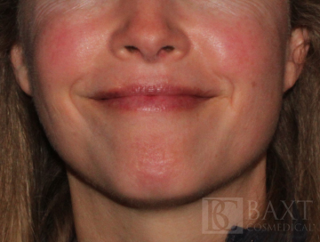 Rosacea Treatment Before - Paramus, NJ Rosacea Treatment Before - Paramus, NJ