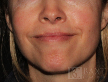 Rosacea Treatment After - Paramus, NJ Rosacea Treatment After - Paramus, NJ