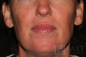 Rosacea Treatment After - Paramus, NJ Rosacea Treatment After - Paramus, NJ