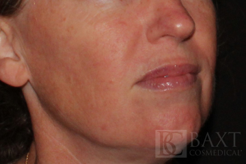 Rosacea Treatment After - Paramus, NJ Rosacea Treatment After - Paramus, NJ