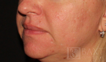 Rosacea Treatment After - Paramus, NJ