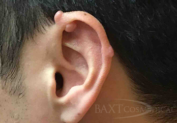 Scar Treatment Before - Paramus, NJ Scar Treatment Before - Paramus, NJ