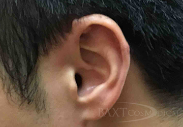 Scar Treatment After - Paramus, NJ Scar Treatment After - Paramus, NJ