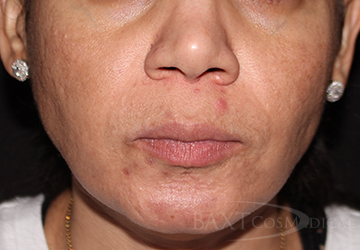 Before Sebacia Acne Treatment Before Sebacia Acne Treatment