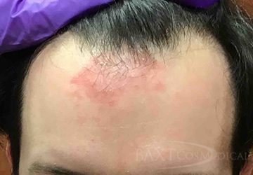 Rash Treatment Before - Paramus, NJ Rash Treatment Before - Paramus, NJ