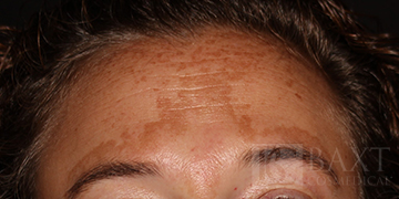 Hyperpigmentation/Melasma Treatment Before - Paramus, NJ Hyperpigmentation/Melasma Treatment Before - Paramus, NJ