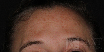 Hyperpigmentation/Melasma Treatment Before - Paramus, NJ