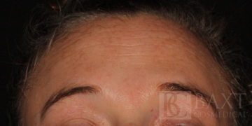Hyperpigmentation/Melasma Treatment Before - Paramus, NJ Hyperpigmentation/Melasma Treatment Before - Paramus, NJ