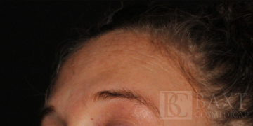 Hyperpigmentation/Melasma Treatment Before - Paramus, NJ Hyperpigmentation/Melasma Treatment Before - Paramus, NJ