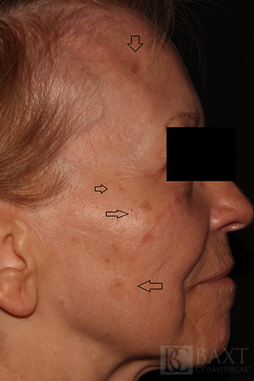Lentigos (sun spots) Before - Paramus, NJ Lentigos (sun spots) Treatment Before - Paramus, NJ