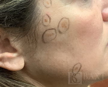 Hyperpigmentation/Melasma Treatment Before - Paramus, NJ Hyperpigmentation/Melasma Treatment Before - Paramus, NJ