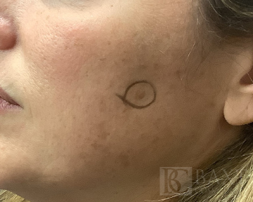 Hyperpigmentation/Melasma Treatment Before - Paramus, NJ Hyperpigmentation/Melasma Treatment Before - Paramus, NJ