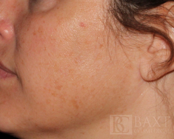 Hyperpigmentation/Melasma Treatment After - Paramus, NJ Hyperpigmentation/Melasma Treatment After - Paramus, NJ