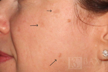 Hyperpigmentation/Melasma Treatment Before - Paramus, NJ Hyperpigmentation/Melasma Treatment Before - Paramus, NJ