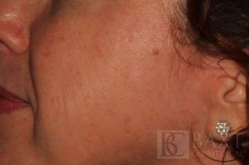 Hyperpigmentation/Melasma Treatment After - Paramus, NJ Hyperpigmentation/Melasma Treatment After - Paramus, NJ