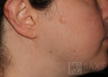 Seborrheic Keratosis Treatment Before - Paramus, NJ Seborrheic Keratosis Treatment Before - Paramus, NJ