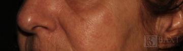 Seborrheic Keratosis Treatment Before - Paramus, NJ