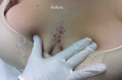 Smoothbeam Treatment Before - Paramus, NJ Smoothbeam Treatment Before - Paramus, NJ
