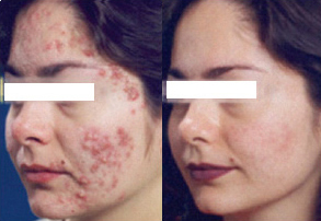 Click Here to View More Isolaz® Acne Treatment Before & After Photos