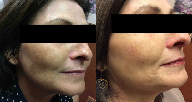 Click Here to View More Chemical Peels Before & After Photos