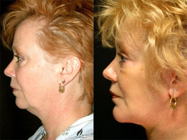 Click Here to View More Neck Contouring Before & After Photos