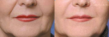 Click Here to View More Restylane® Before & After Photos
