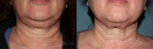 Click Here to View More Kybella® Before & After Photos