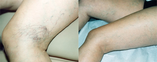 Click Here to View More Sclerotherapy Before & After Photos