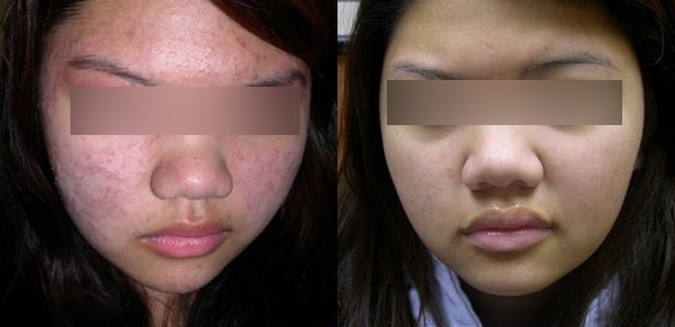 Click Here to View More Photodynamic Therapy Before & After Photos